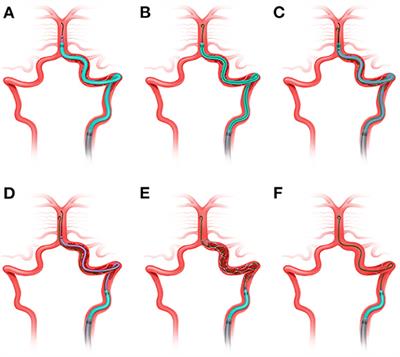 Frontiers Preliminary Experience With Recanalization Of Large Vessel